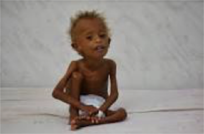 Starving child of Yemen